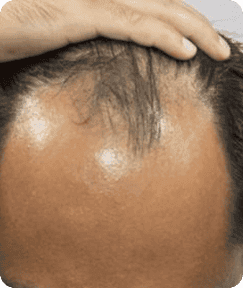 Kebotakan pola M atau U