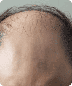 Rambut tipis dan mudah rontok