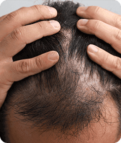 Kerontokan berlebihan