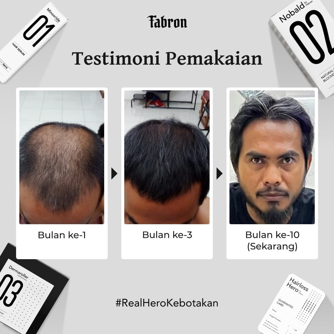 (e-voucher) Hairloss Hero Package - Treatment Kebotakan Pria