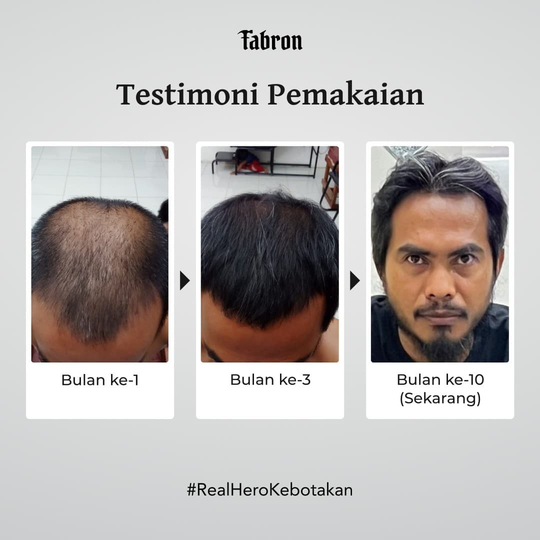 (e-voucher) Minoxride - Hair Starter Treatment