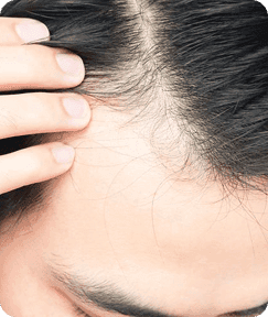 Garis rambut mundur