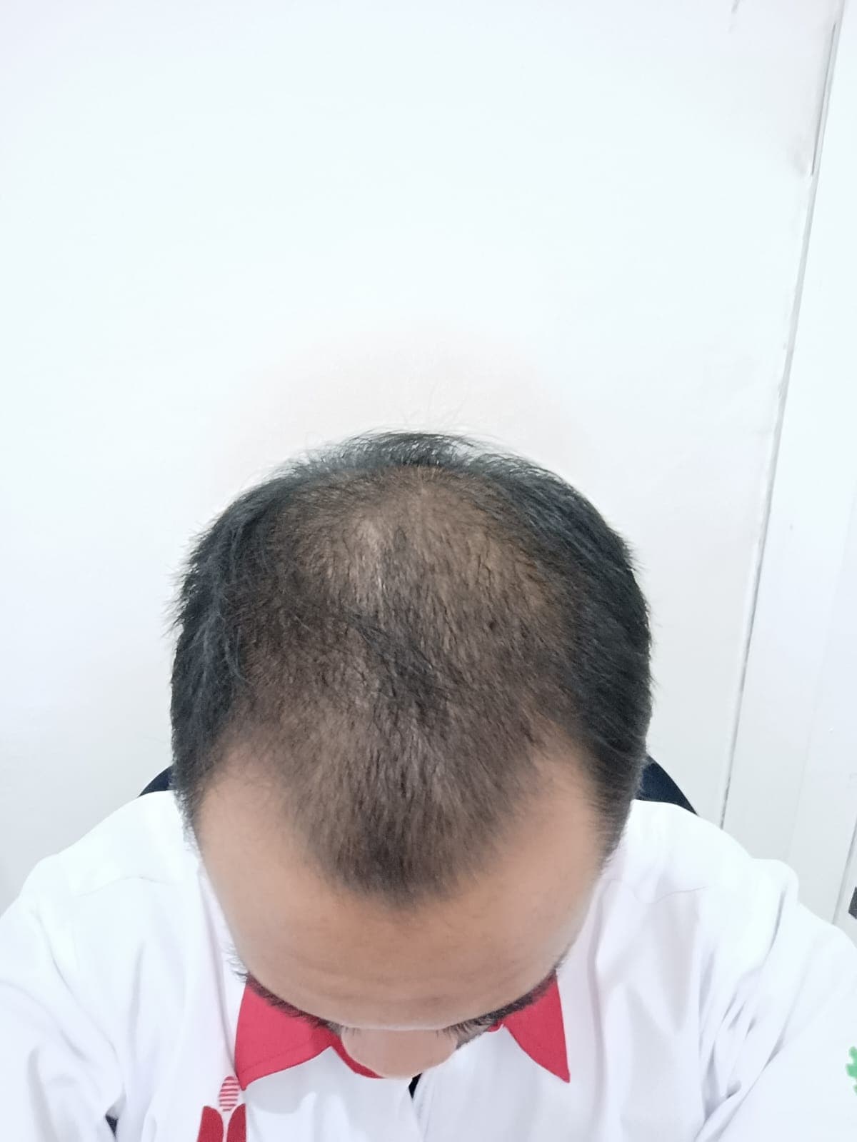 Before - Fahri